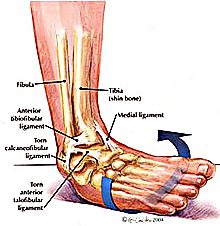 broken-tibia-2695360
